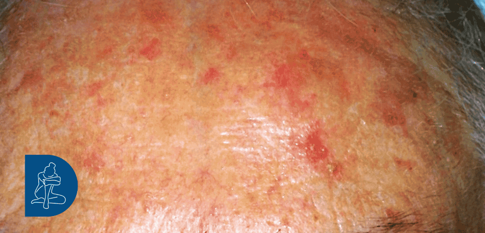 cheratosi attinica in fronte - dermaclub