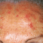 cheratosi attinica in fronte - dermaclub