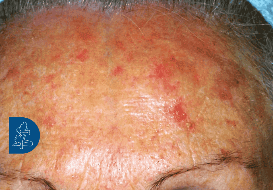 cheratosi attinica in fronte - dermaclub