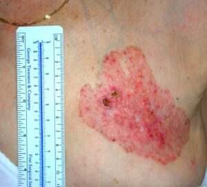 epitelioma basocellulare pianocicatriziale