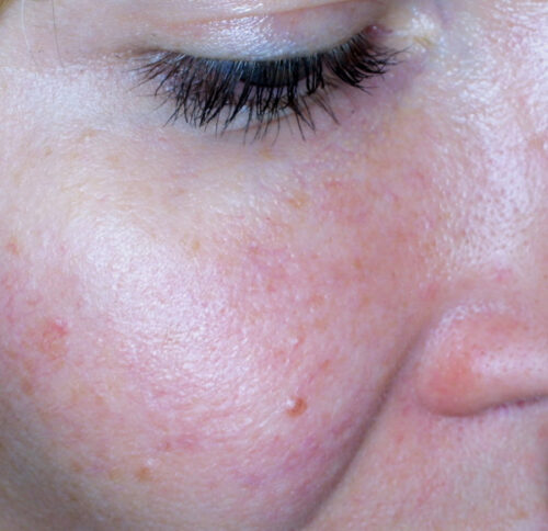 Immagine ravvicinata di pelle sensibile sulla guancia con arrossamento diffuso