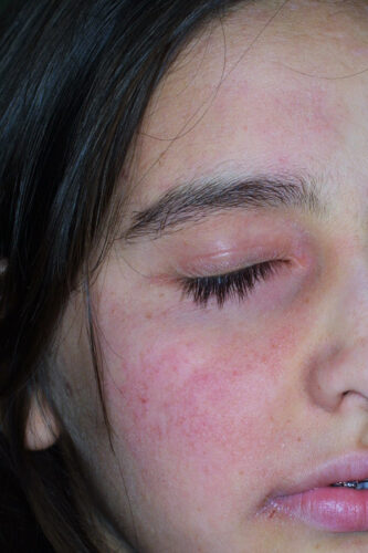 Immagine di viso con pelle sensibile che mostra arrossamento diffuso su guancia e palpebra, tipico segno di reattività