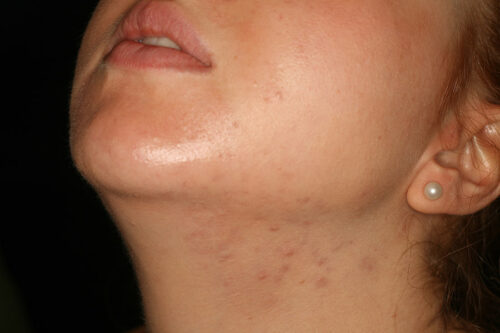 Immagine di pelle sensibile del viso con piccole follicoliti e imperfezioni visibili su guancia e zona mandibolare