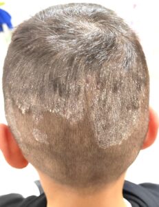 DS000 dermatite seborroica cuoio capelluto bambini - dermaclub