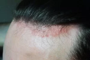 Dermatite-seborroica-14 Escoriazioni dovute da Dermatite Seborroica del Cuoio Capelluto sulla fronte - Dermaclub