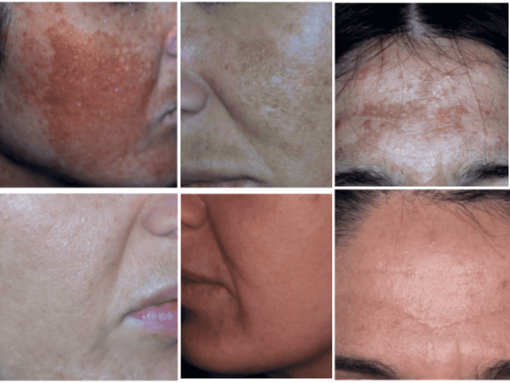tre immagini di volto di donne diverse prima e dopo trattamento melasma di Dermaclub