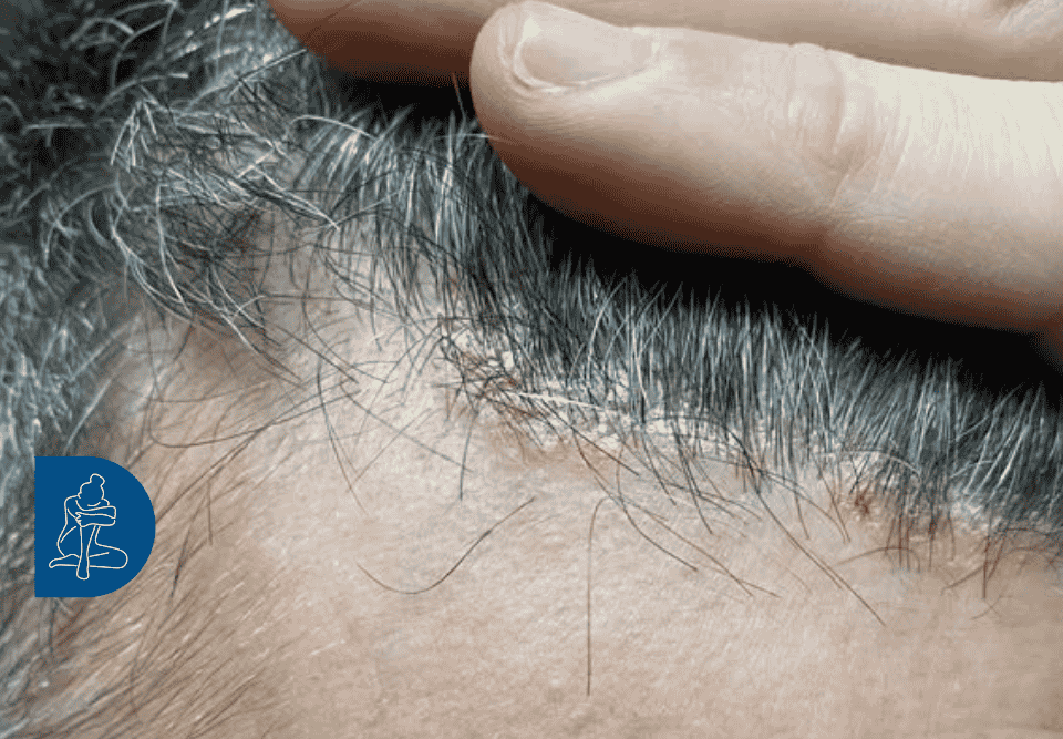 Prurito e fastidio in testa causati da Dermatite Seborroica del Cuoio Capelluto - Dermaclub