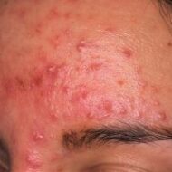 acne-ros--300x200