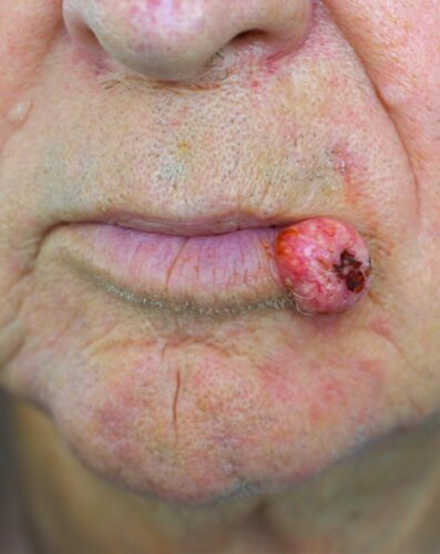 carcinoma squamocellulare del labbro