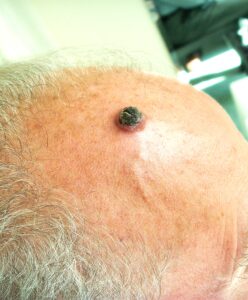 carcinoma squamocellulare nodulare - DermaClub