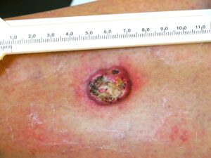 carcinoma squamocellulare nodulare ulcerato