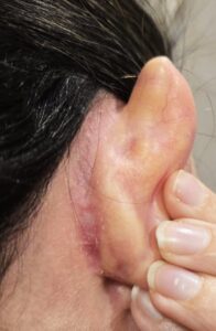 da0 dermatite seborroica orecchio - dermaclub