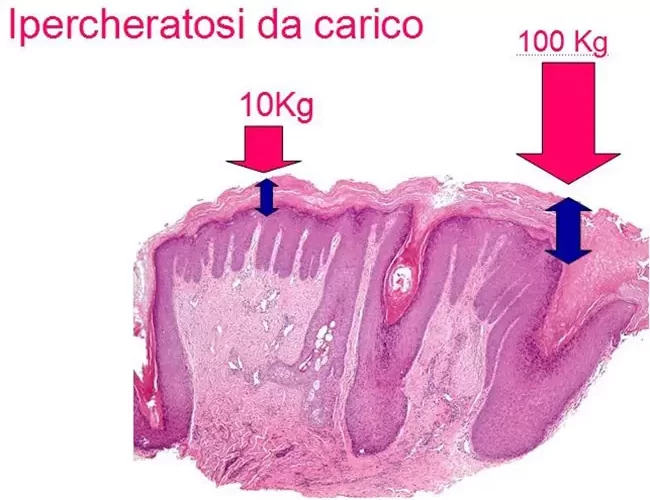 ipercheratosi-da-carico