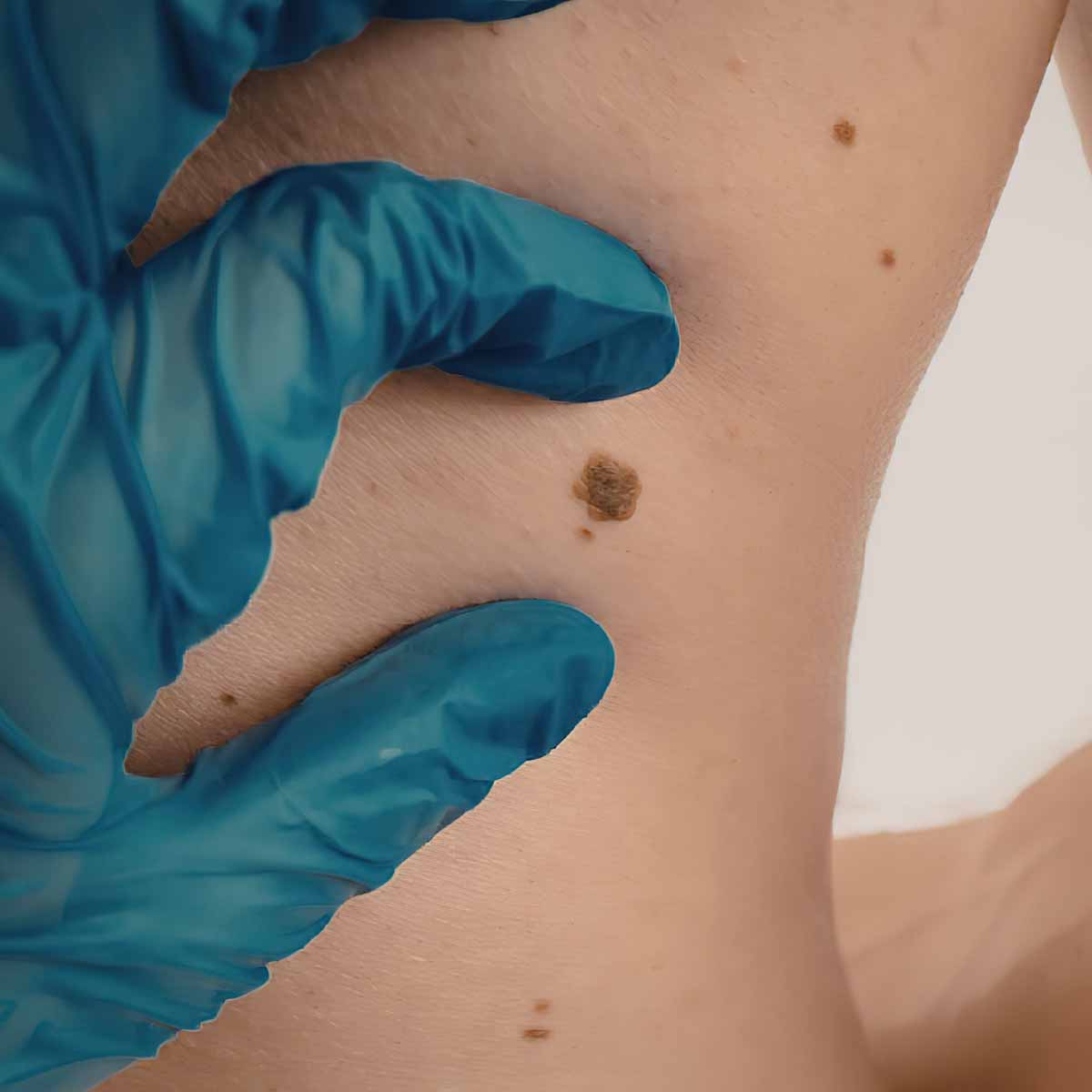 dermatologo che analizza melanoma su schiena