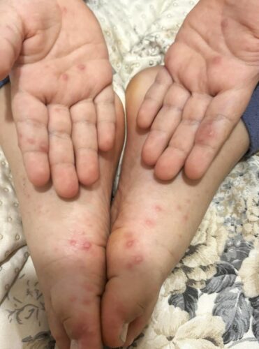 malattia mani-piedi-bocca nei bambini - dermaclub