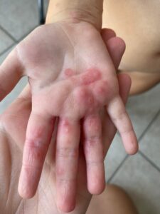 malattia mani-piedi-bocca bambini - dermaclub