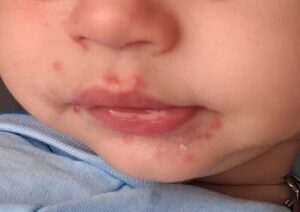 Malattia Mani-Piedi-Bocca bambini: i sintomi e come si manifesta - Dermaclub