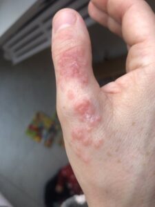 malattia mani-piedi-bocca adulti - dermaclub