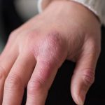 Immagine di geloni sulle dita della mano con pelle arrossata, gonfia e desquamante causati dall'esposizione al freddo